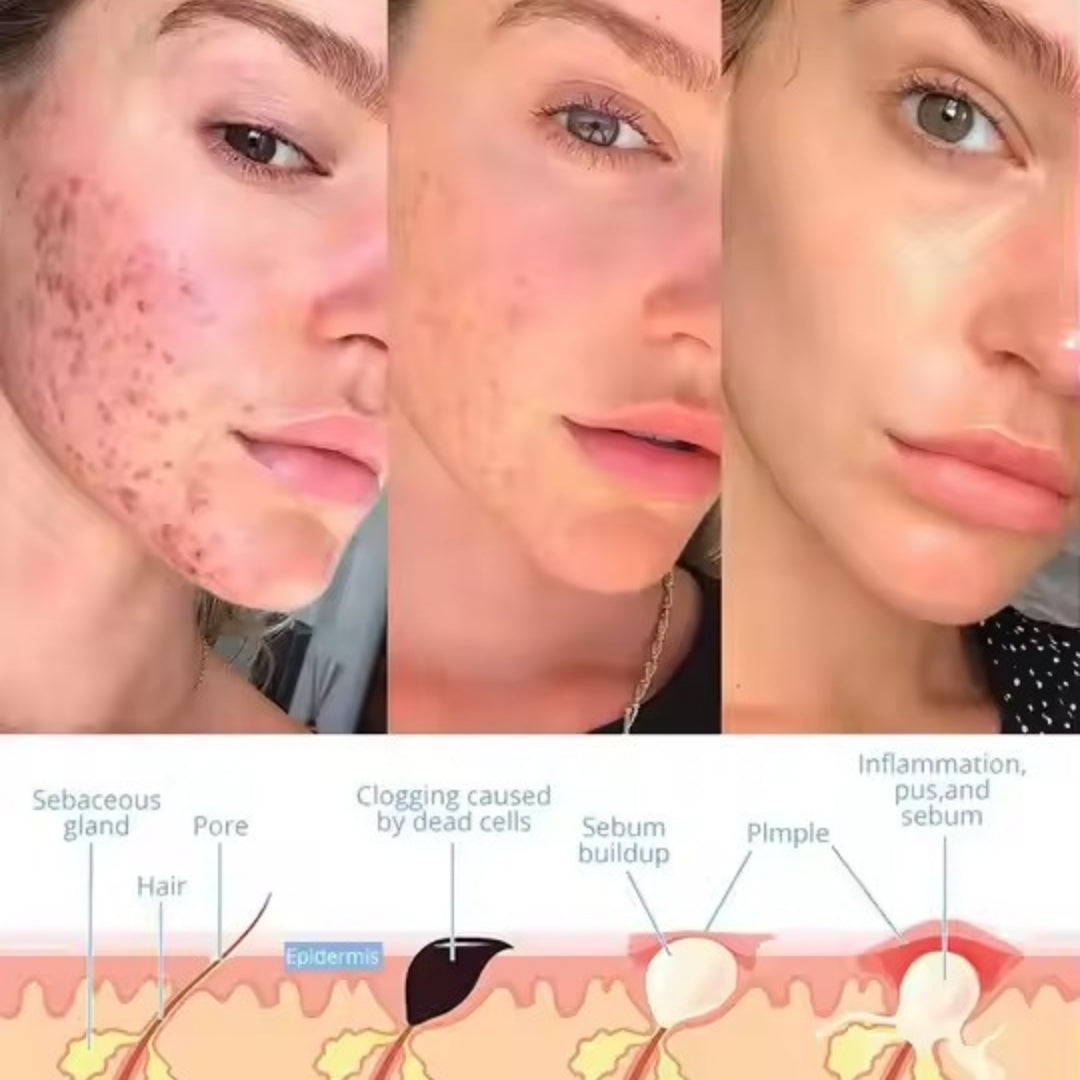 FaceVolt™ - Facial Wand